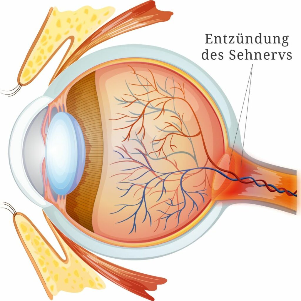 MS 1zu1 - Welt-Multiple-Sklerose-Tag | Auswirkungen auf die Augen - Augenärzte Gerl & Kollegen