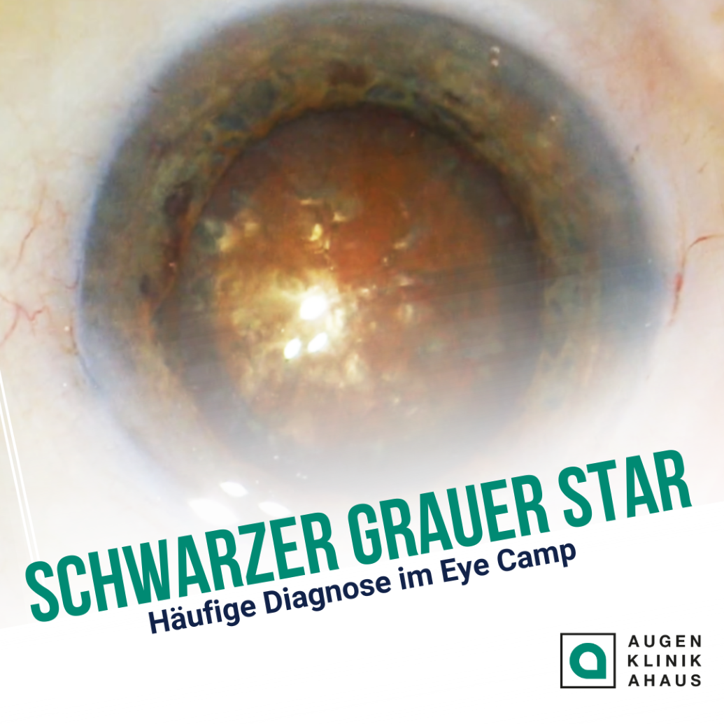 uganda cataract 1 1zu1 - Uganda Eye-Camp 3.0 | Häufige Diagnose: Schwarzer Star - Augenärzte Gerl & Kollegen